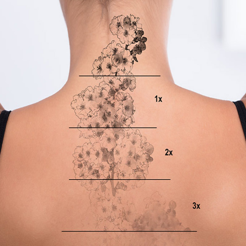 Laser treatment tattoo removal results shown in phases on a woman's back.